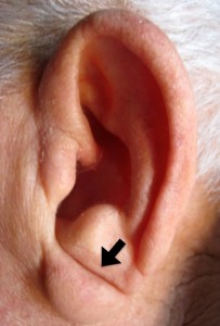 OREJA CON ECV-1