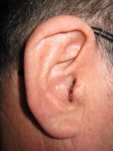 OREJA SIN ECV
