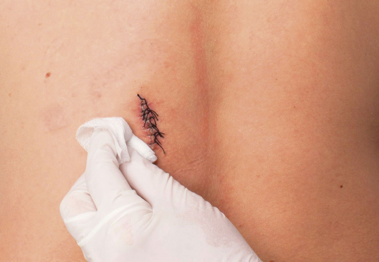 fases de la cicatrización