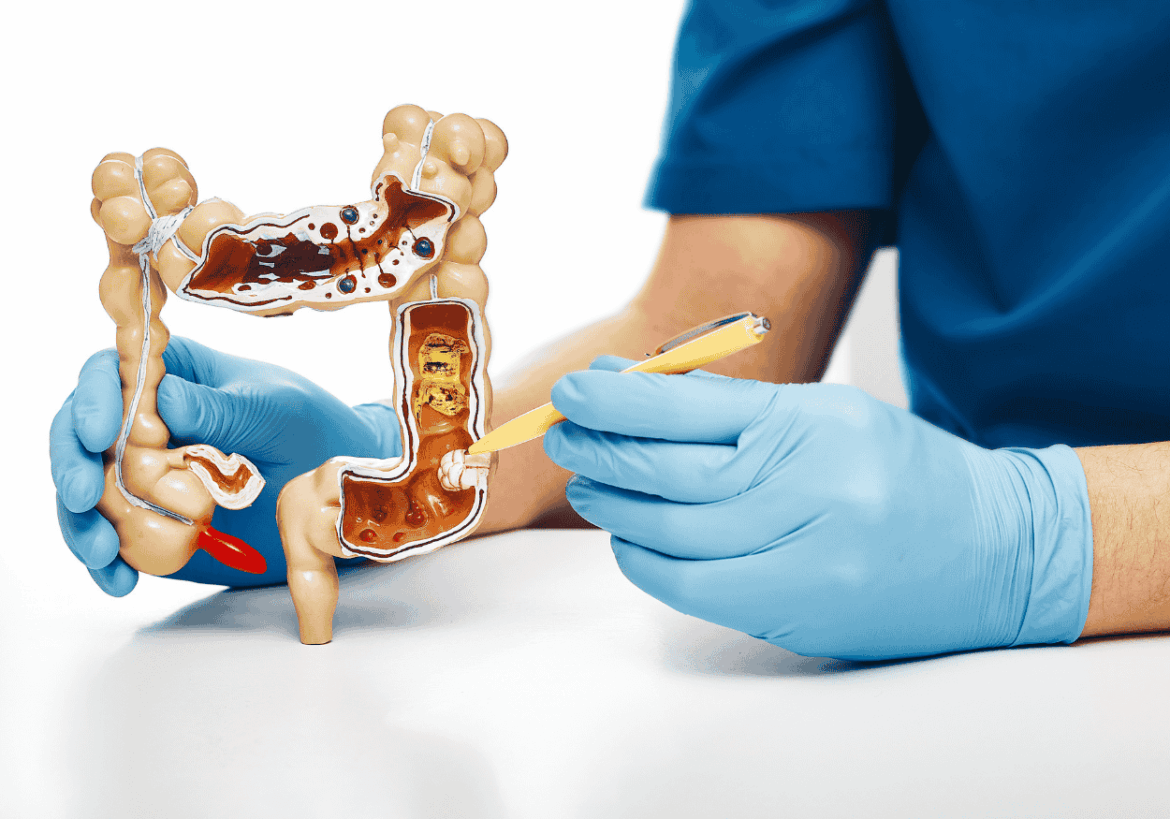 tumor colorrectal
