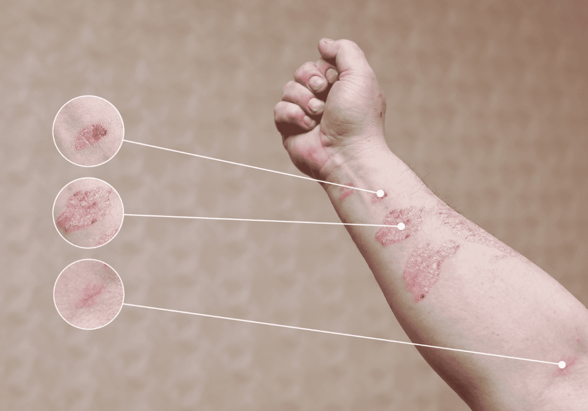 impacto emocional de la psoriasis