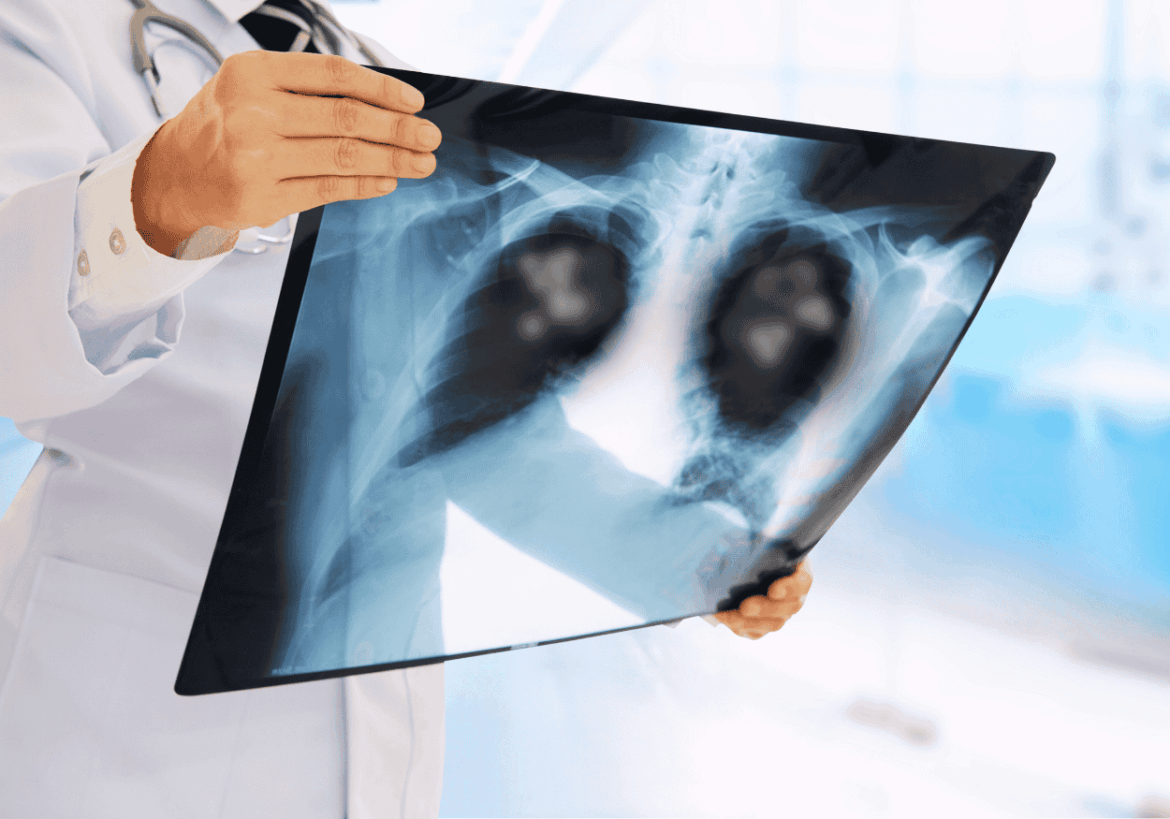 complicaciones de la gripe