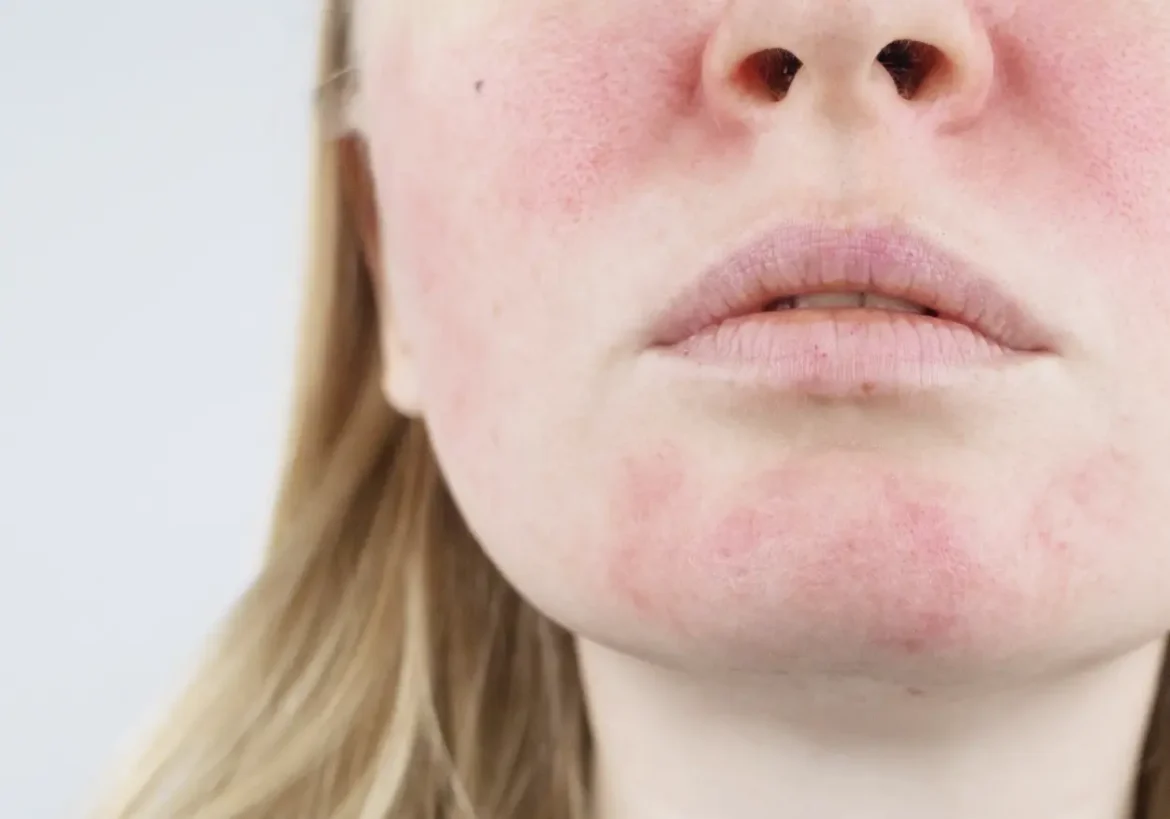 tratamiento para la rosacea