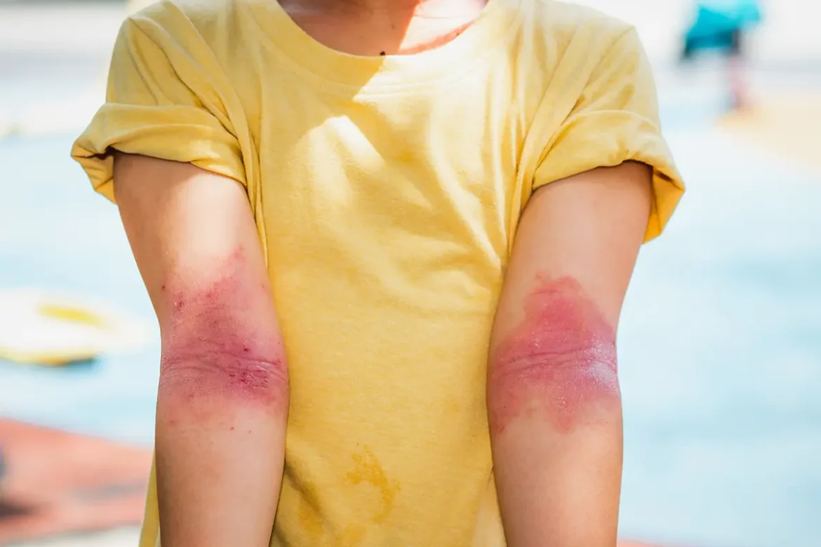 impacto de la dermatitis atópica severa