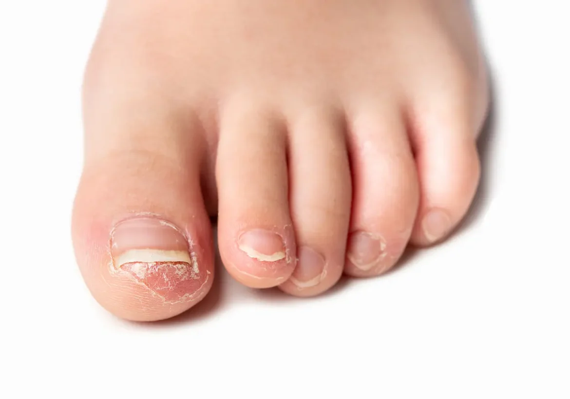 micosis típicas del verano