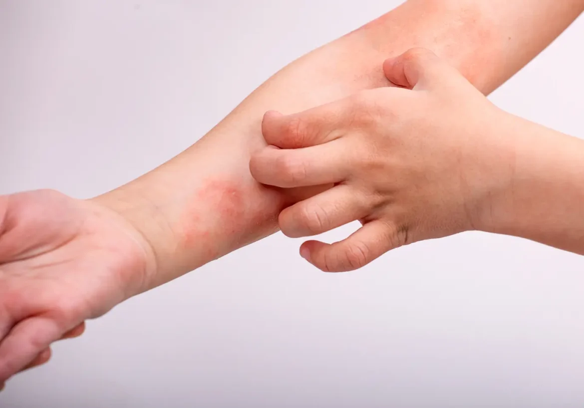 claves para tratar la dermatitis atópica