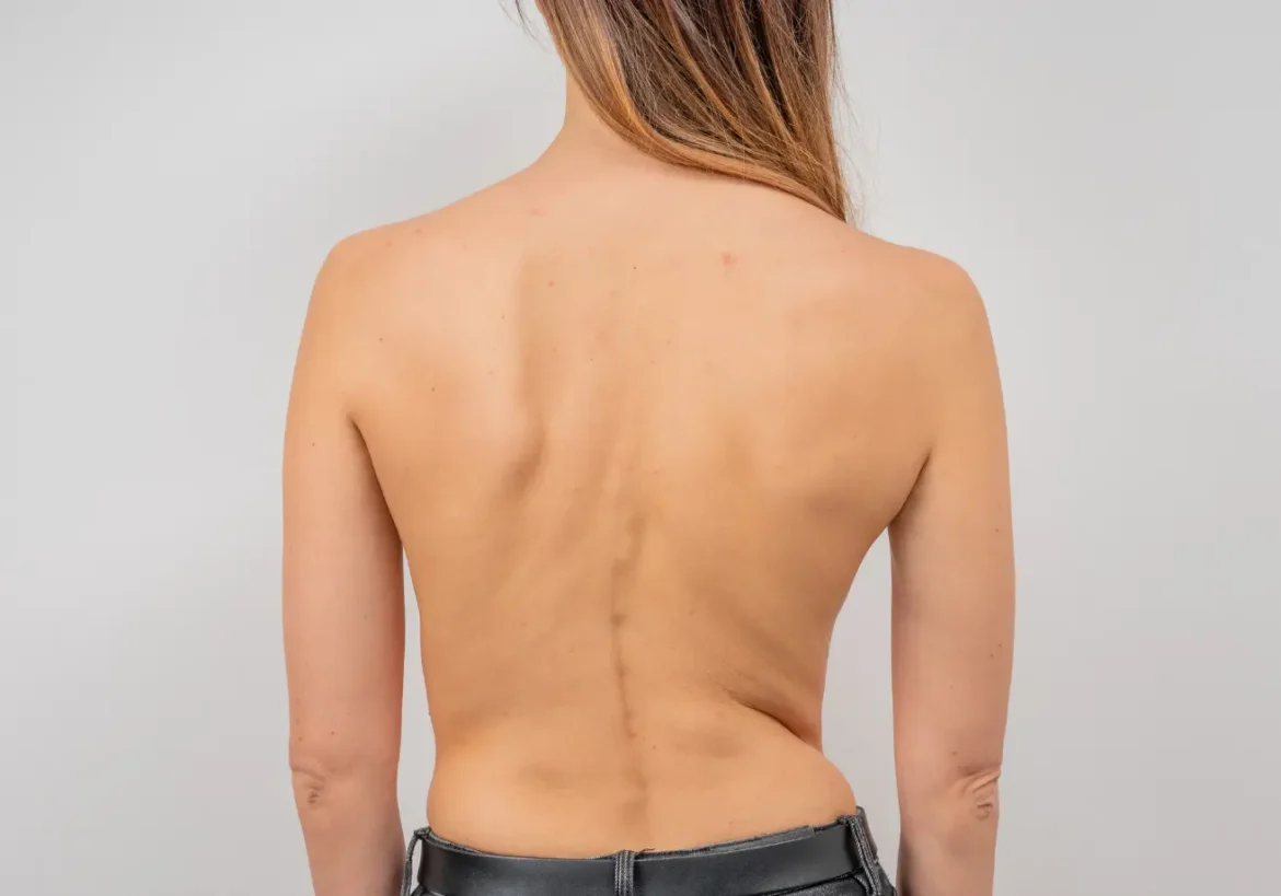 corsé para tratar la escoliosis
