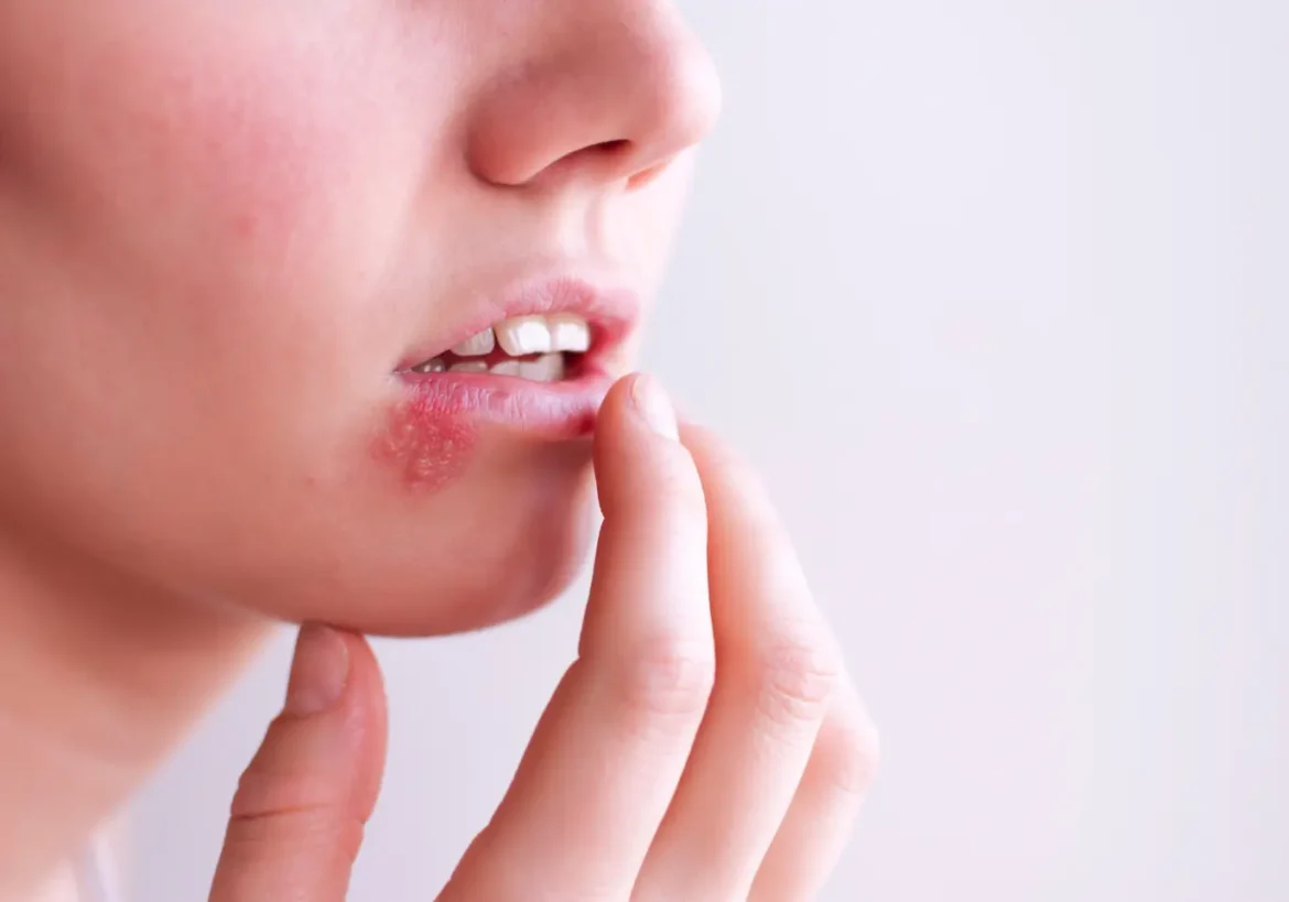 prevenir el herpes labial