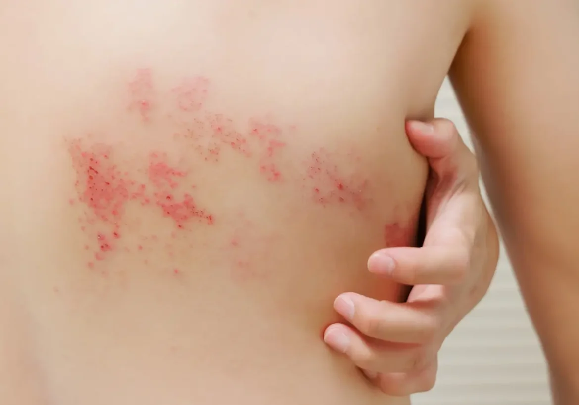 virus del herpes zóster