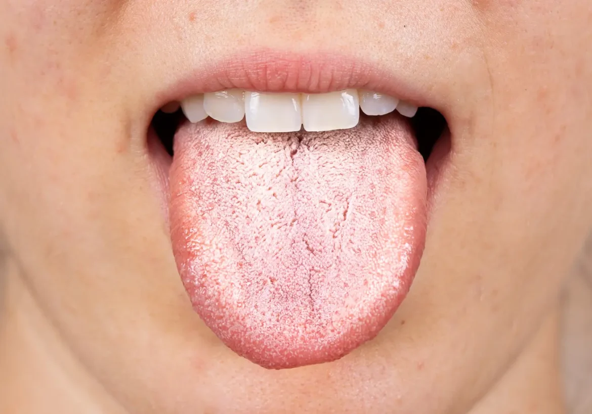 las causas de la lengua blanca